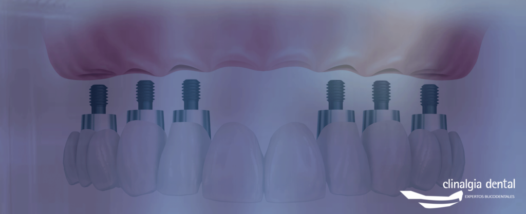 Implantes dentales Clinalgia Dental