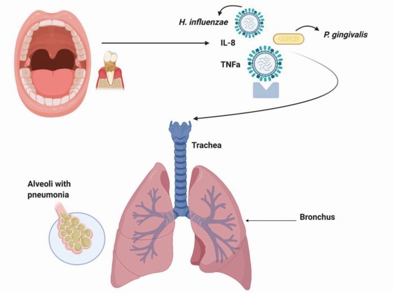 Influencia de la higiene oral en la prevención de infecciones respiratorias